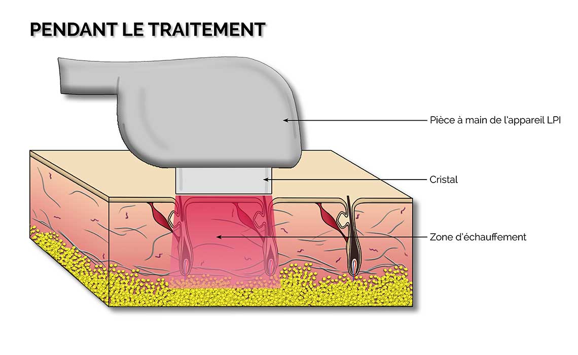 epilation LPI toulouse