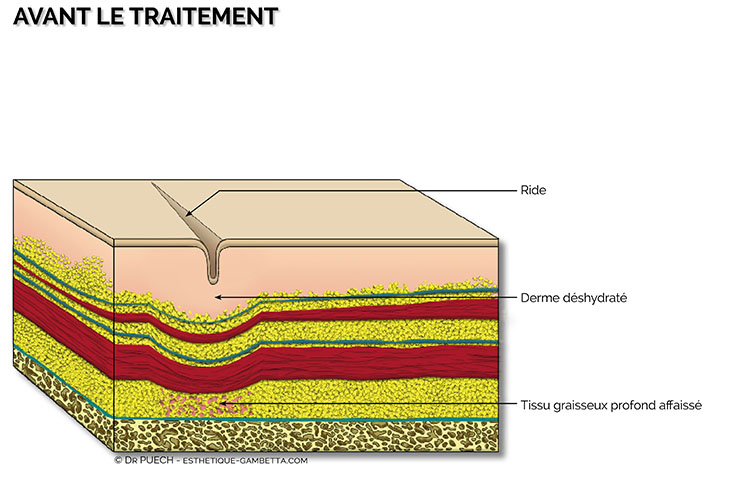 injection acide hyaluronique toulouse