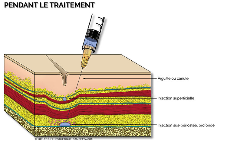 definition de l'acide hyaluronique