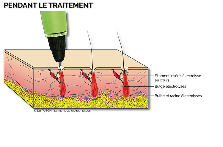 pendant l'épilation par electrolyse