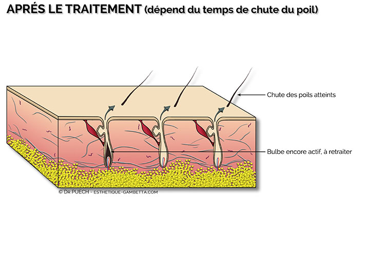 apres l'épilation electrique