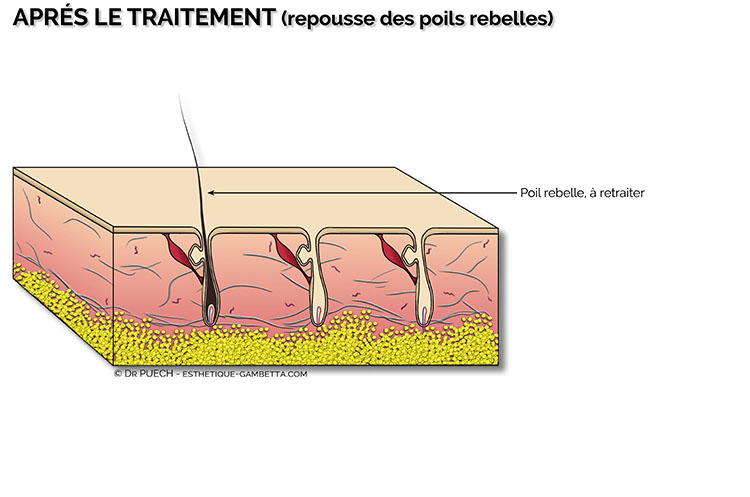 epilation electrique, repousse de poils rebelles