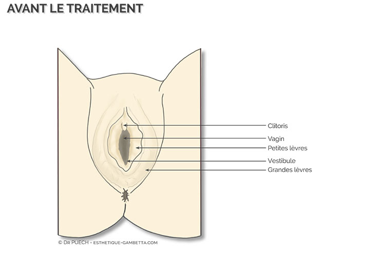 rejuvenation vulvaire avec desirial Toulouse