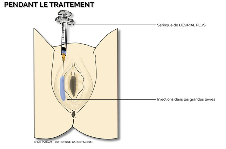 DESIRIAL : rajeunissement de la vulve à Toulouse