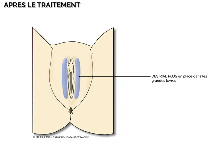 desirial en rajeunissement vulvaire à Toulouse