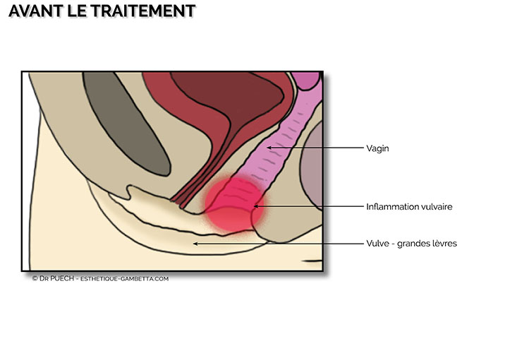 injections desirial acide hyaluronique dans le vestibule