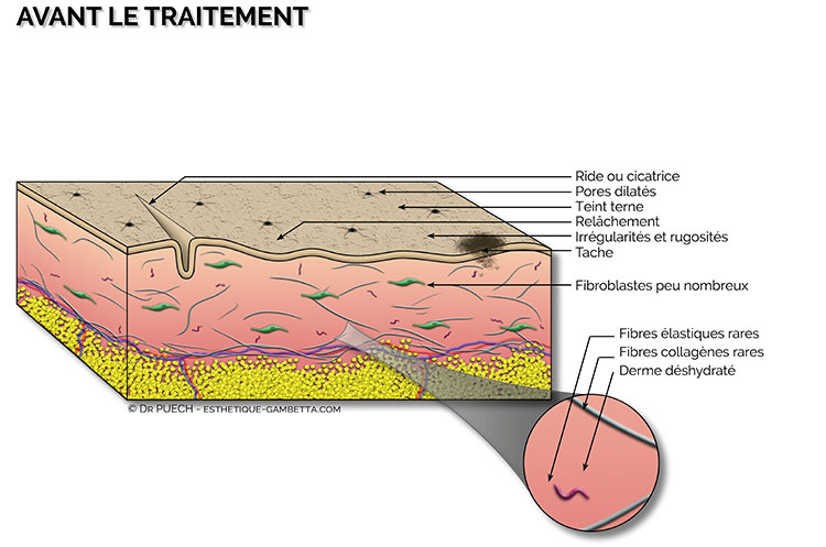 peeling superficiel dermatologique