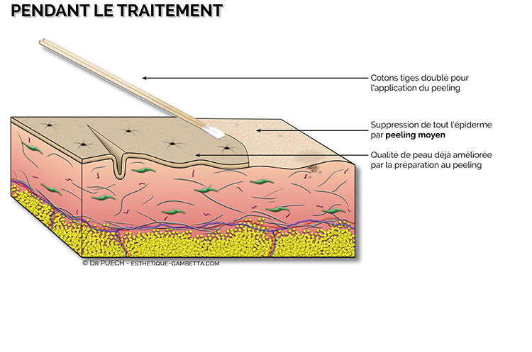 peeling moyen medecine esthetique