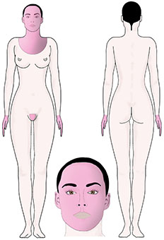injection acide hyaluronique