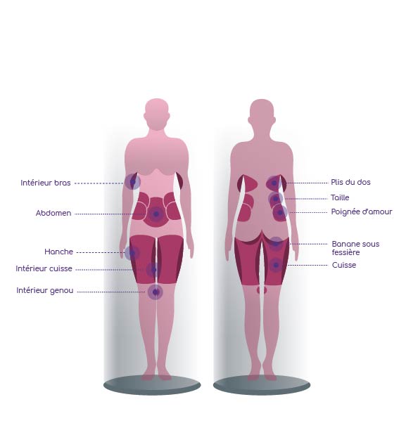 CRYOLIPOLYSE - Zones de traitement