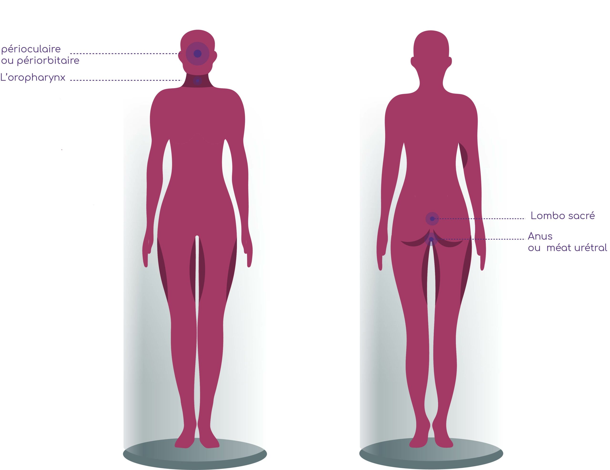 HEMANGIOME INFANTILE - Zones de traitement